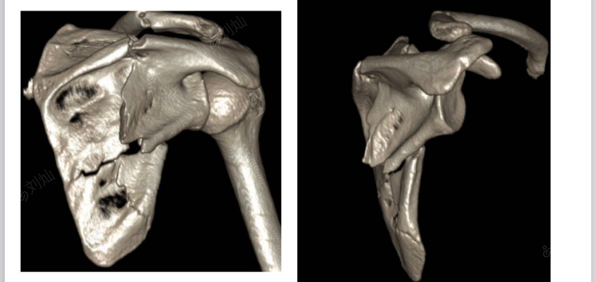 右肩胛骨骨折手术