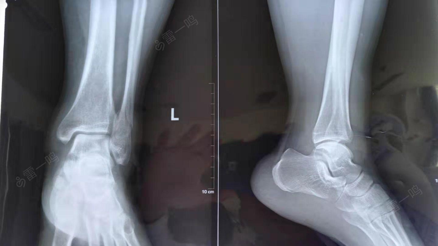 右外踝骨折长骨痂图片图片