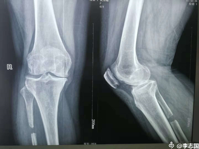 膝关节保守治疗一例