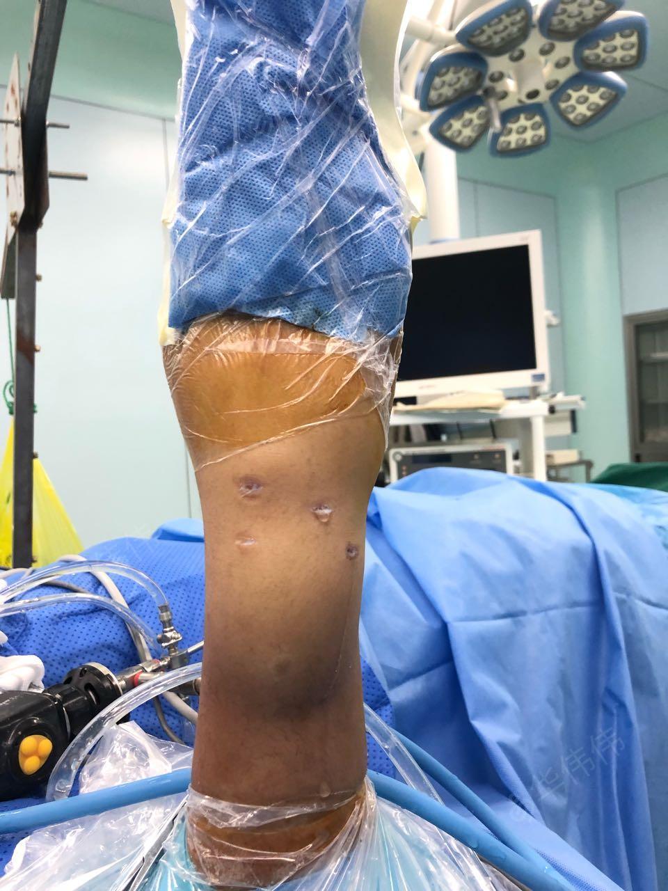 关节镜下腕关节背侧囊肿切除 腕关节清理