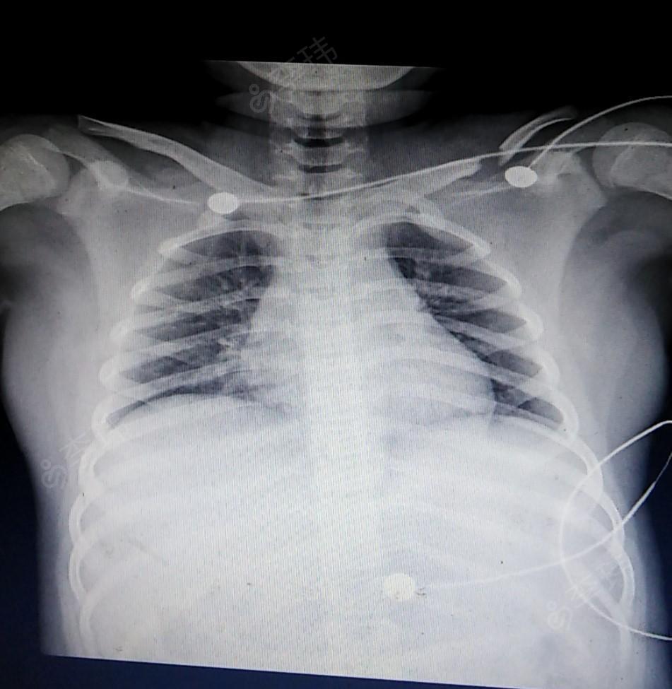 磁共振胸锁关节平扫图片