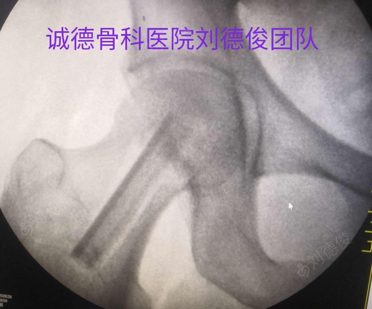 股骨頭壞死遊離左腓骨瓣移植術