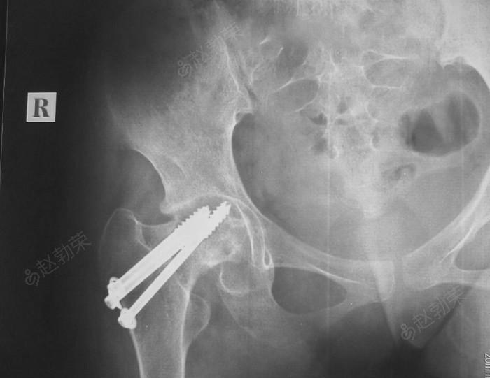 女,18岁,股骨颈骨折内固定后股骨头坏死