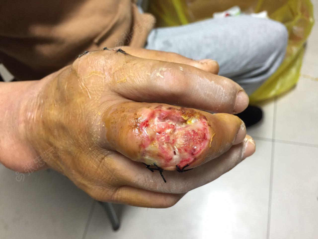 男66岁,右手中指近侧指间关节结节破溃