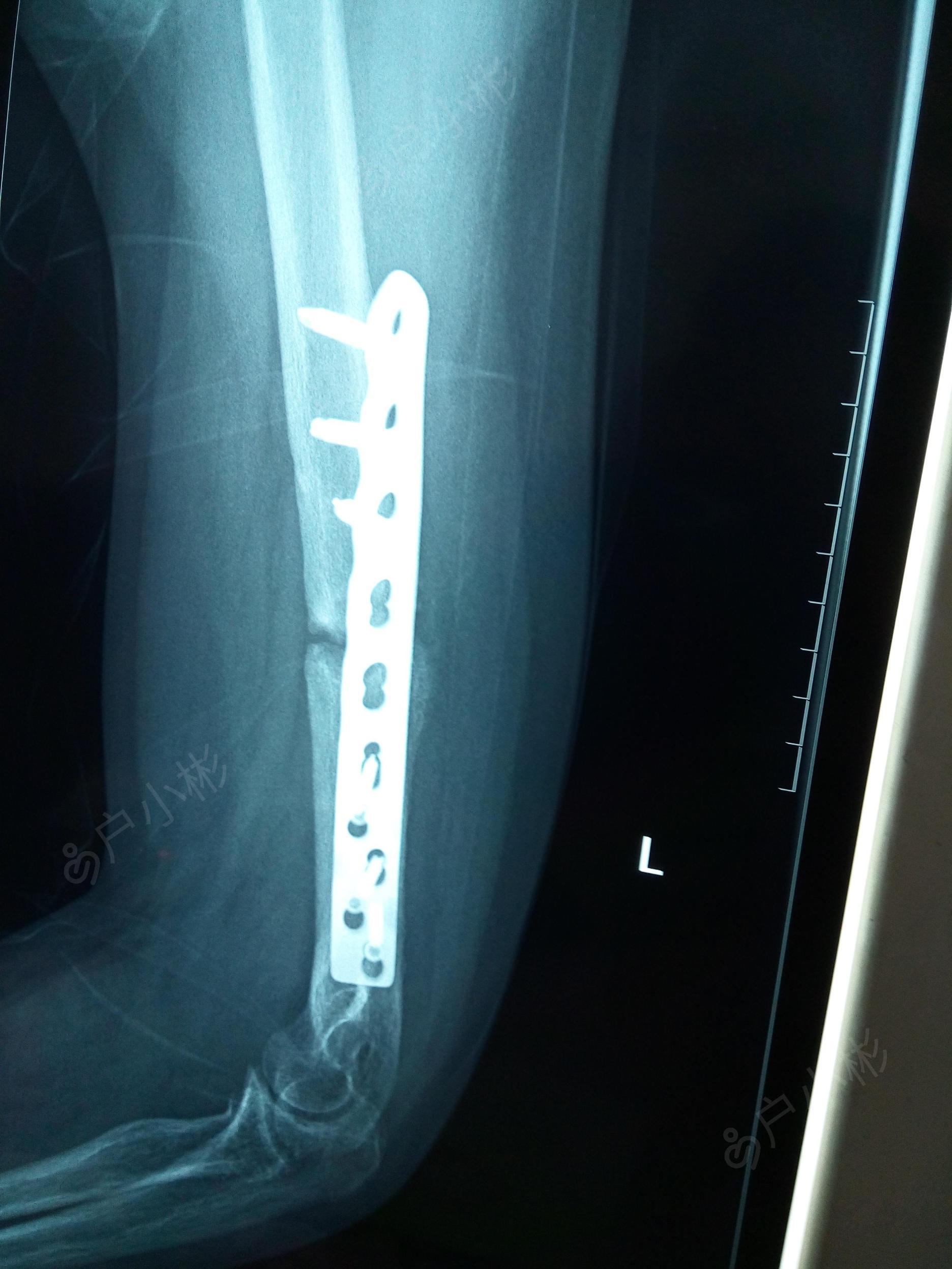 肱骨干骨折x线图片