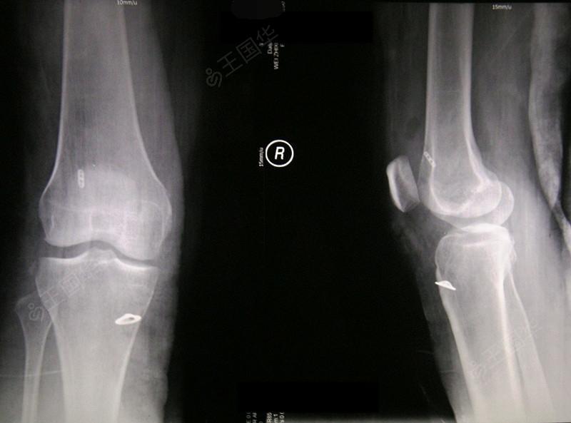 前交叉韧带断裂图片