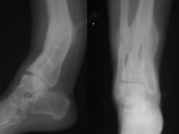 左腓骨远端斜线骨折一岁小孩被重物压伤导致左小腿胫腓骨远端