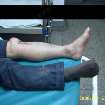 男54,胫腓骨骨折,骨筋膜室综合症