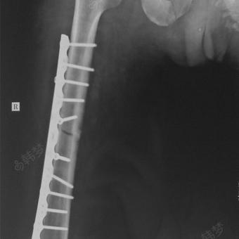 骨盆骨折外固定支架因高处坠落摔伤 骨盆骨折错位 手术钢板固定 外固定架 现 寻