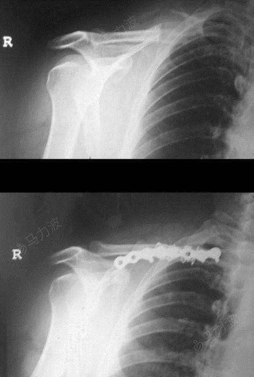 锁骨粉碎性骨折图片图片