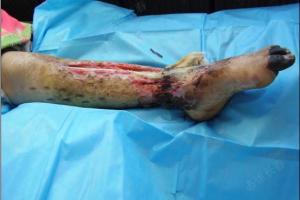 男35岁,左小腿骨筋膜室综合症肌肉软组织坏死缺失是否保肢?