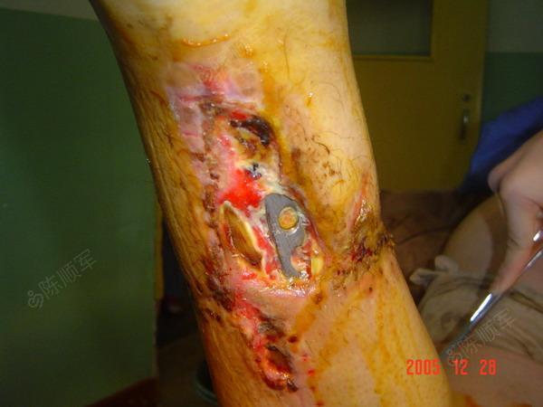 45岁男,胫骨骨折术后内侧钢板外露