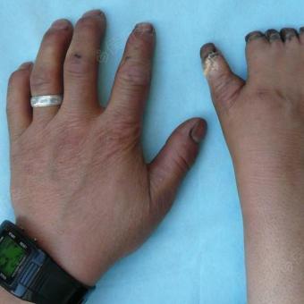 女,28岁,先天性短指并指畸形