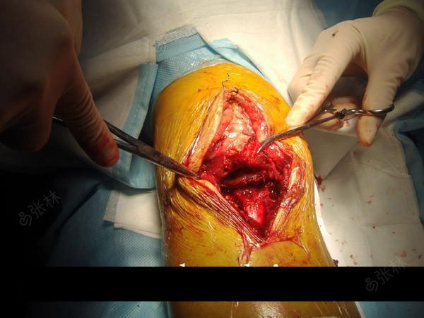 女, 52岁, 中老年右胫骨结节撕脱骨折