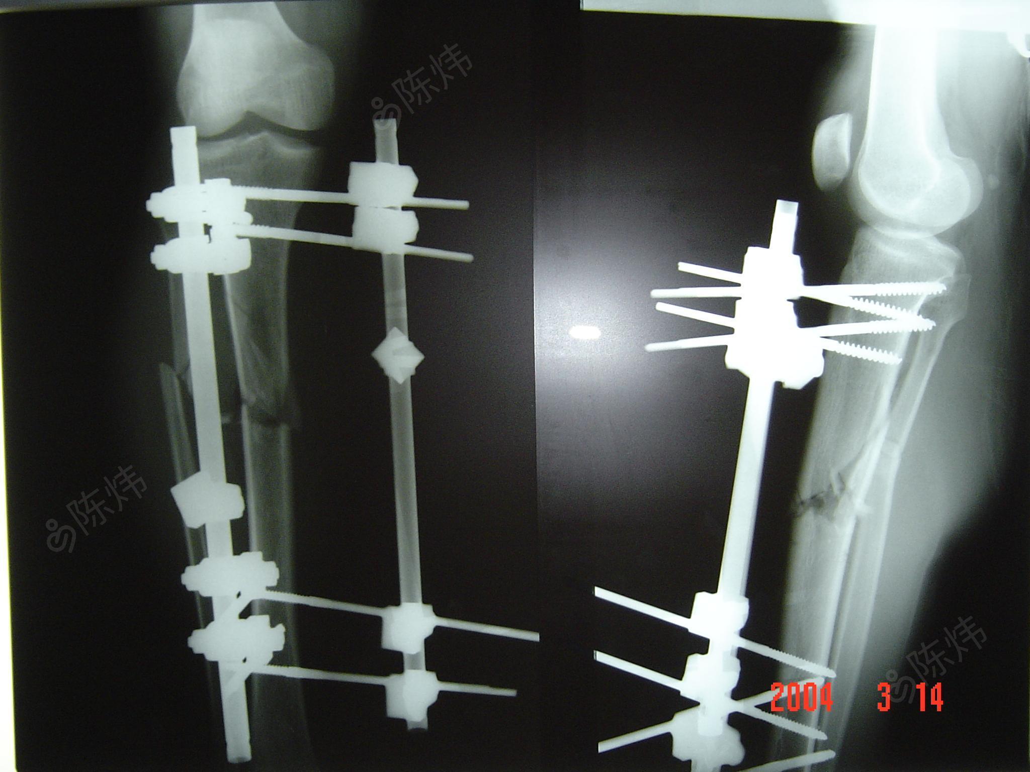 肩肘固定支具-骨折外固定支架-骨科康复器材