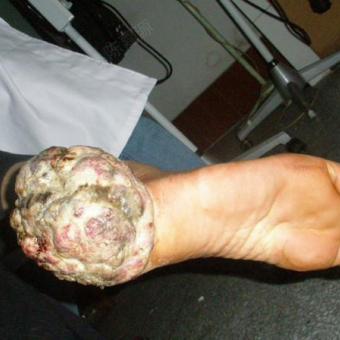 右足跟"黑色素瘤"手术方式?