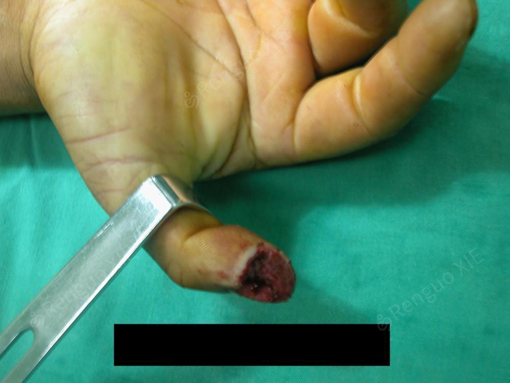 手指骨膜损伤图片图片