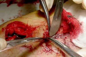 男,42岁,左小腿高能撞击伤,胫骨开放性粉碎性骨折,腓骨骨折