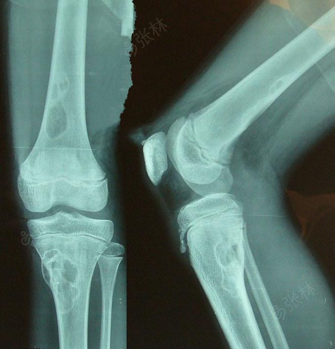 男,13岁,左膝关节
