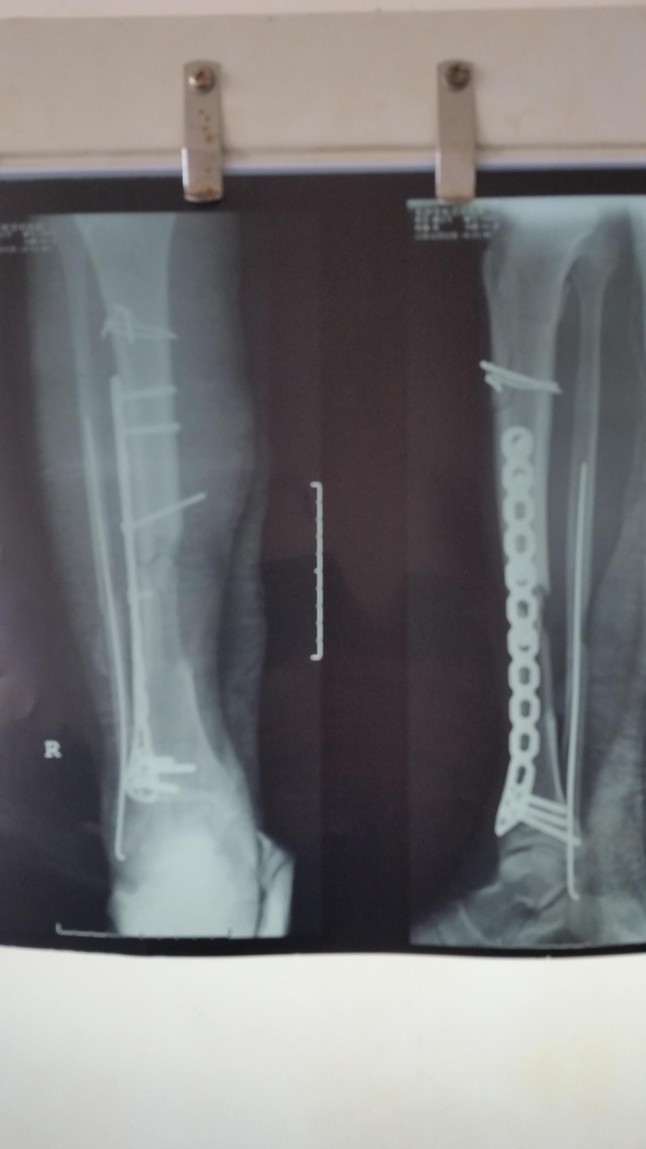 膝关节脱位，前后交叉韧带及内侧副韧带损伤，一期重建。 - 微医（挂号网）