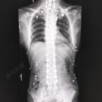 AS腰椎骨折,L2-3经间盘类chance骨折