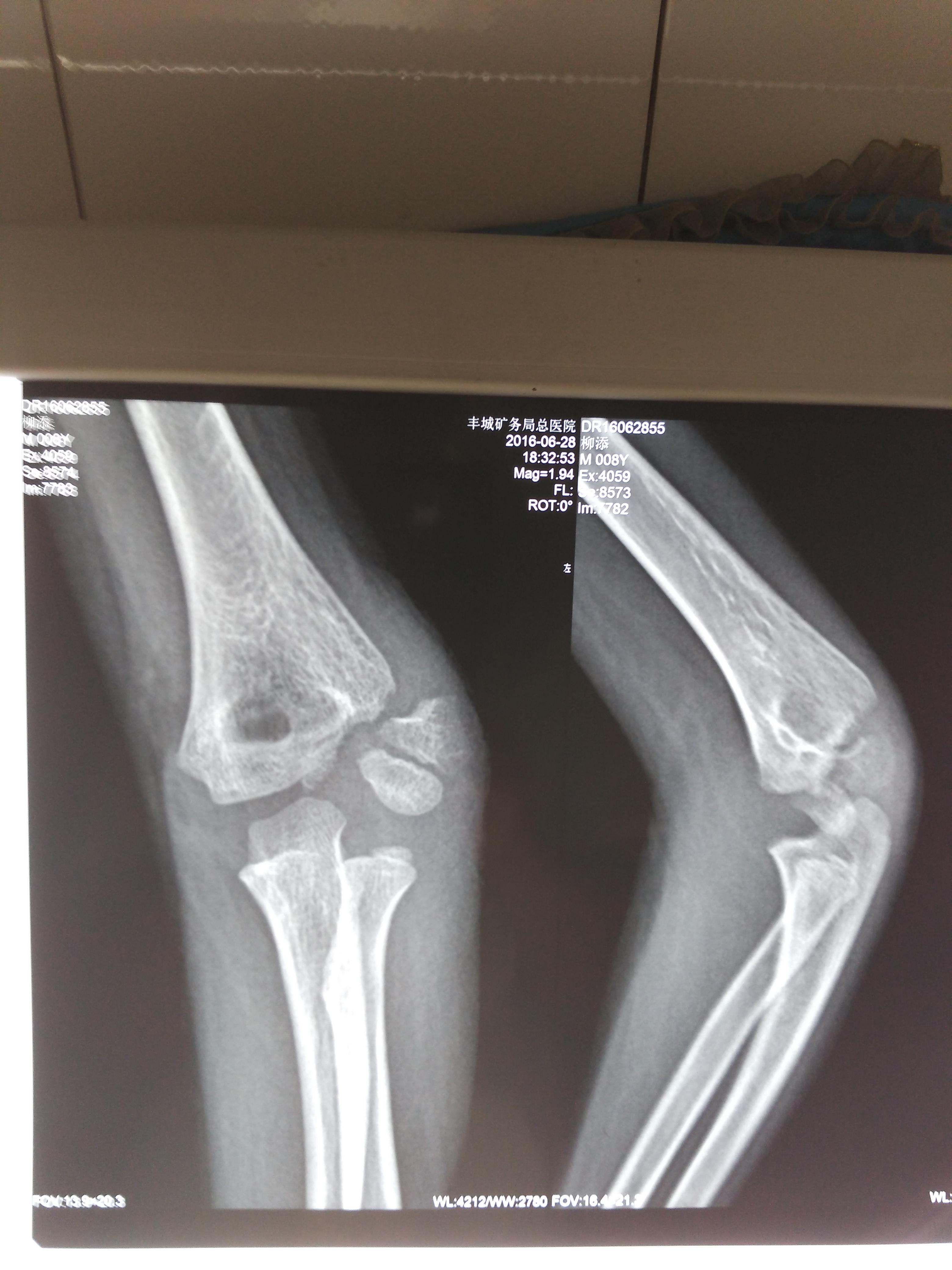 左肱骨外髁骨骺3型损伤闭合复位经皮穿钉内固定术