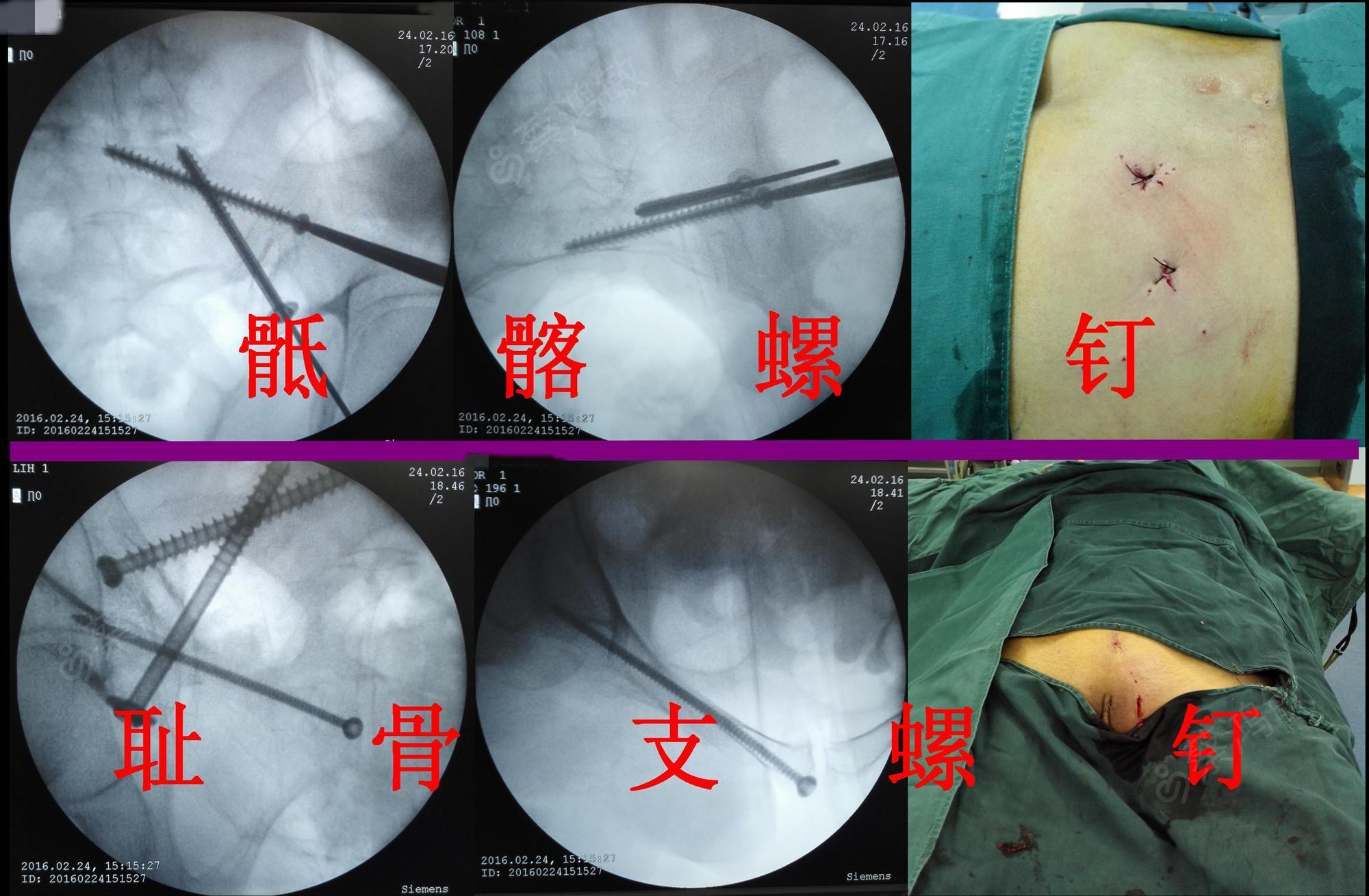 骨盆脆性骨折(ffp)的治療——骶髂螺釘 恥骨上支螺釘-病例討論-唯醫,a