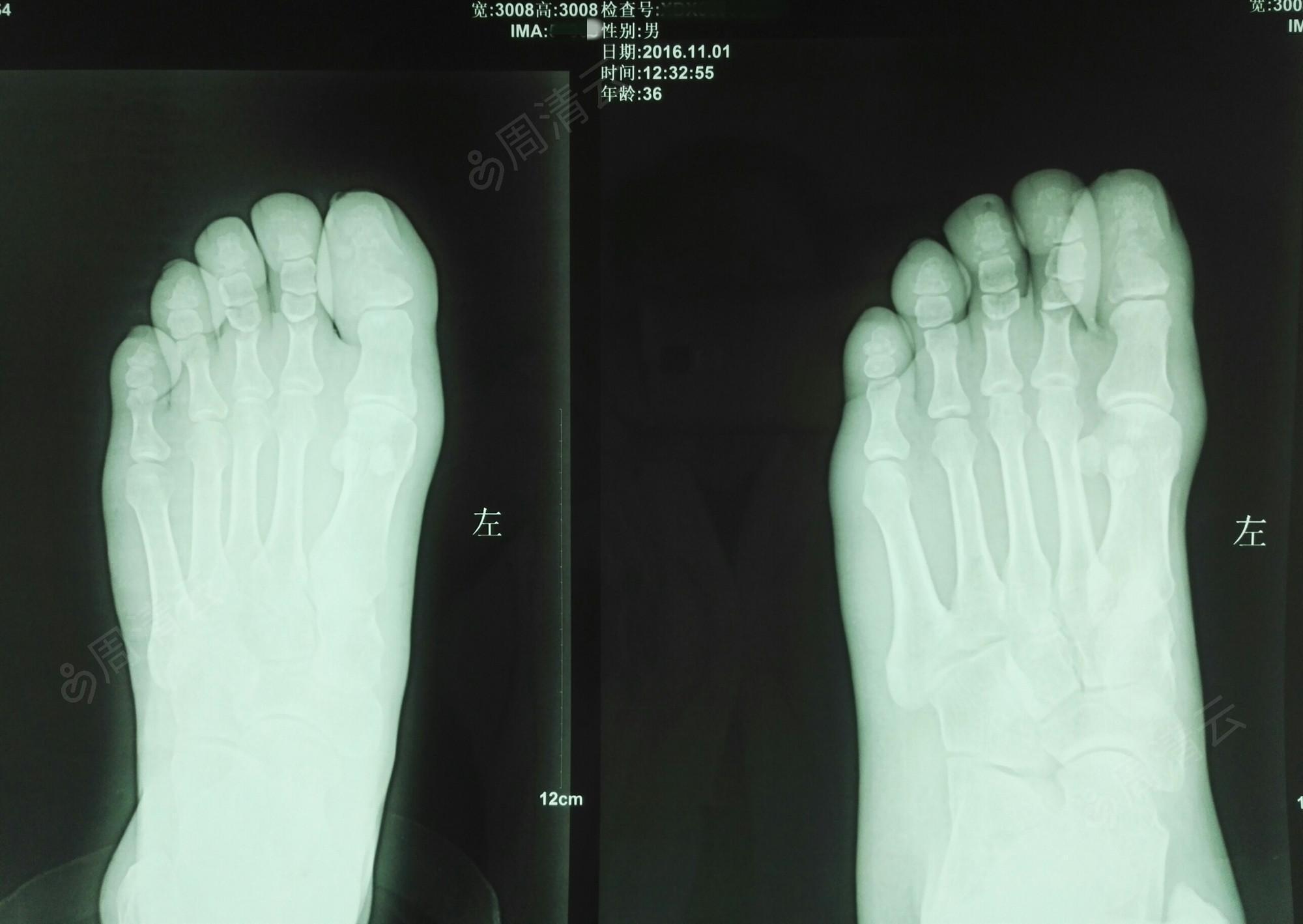 脚远节指骨骨折图片图片