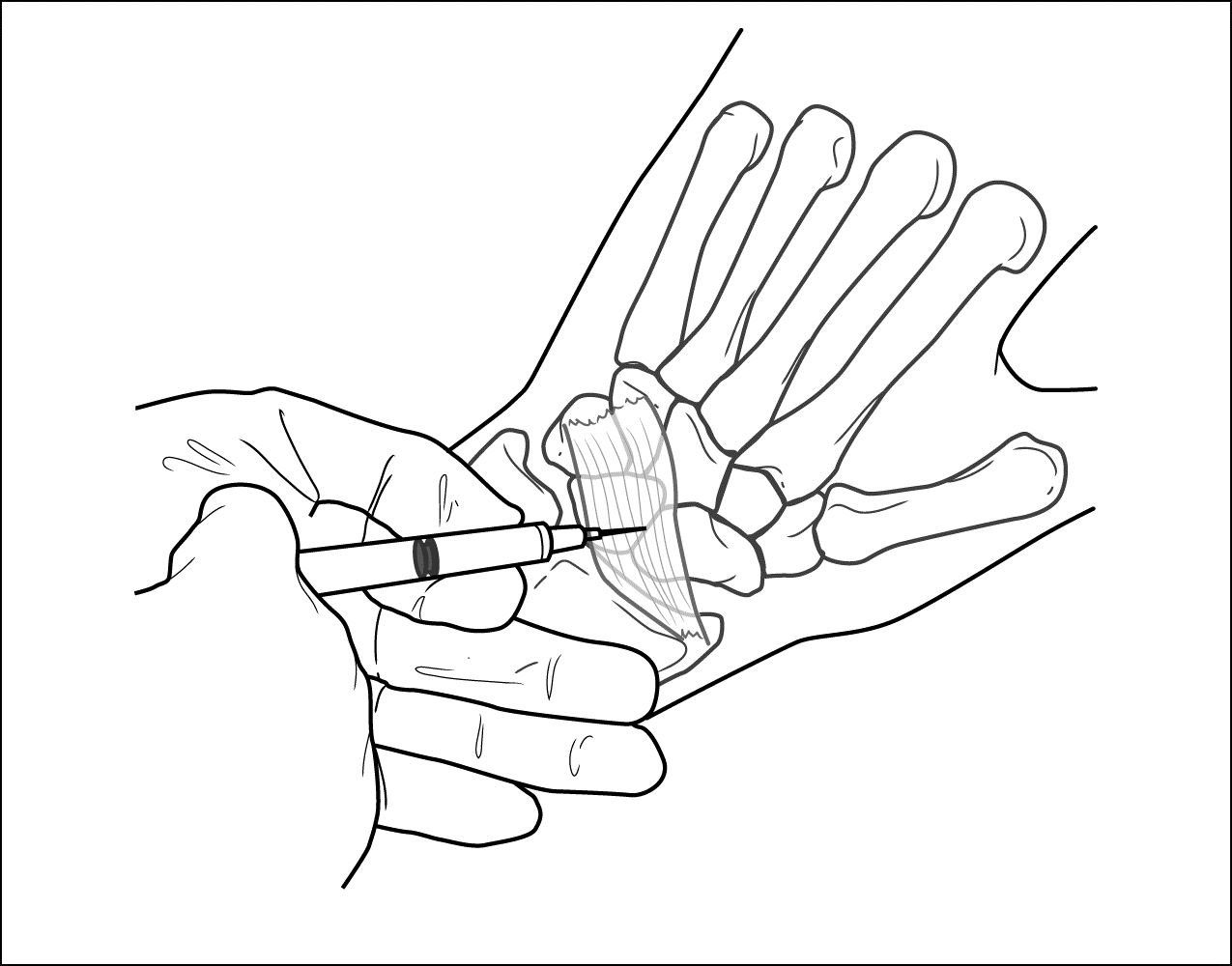 腕关节注射术步骤图片