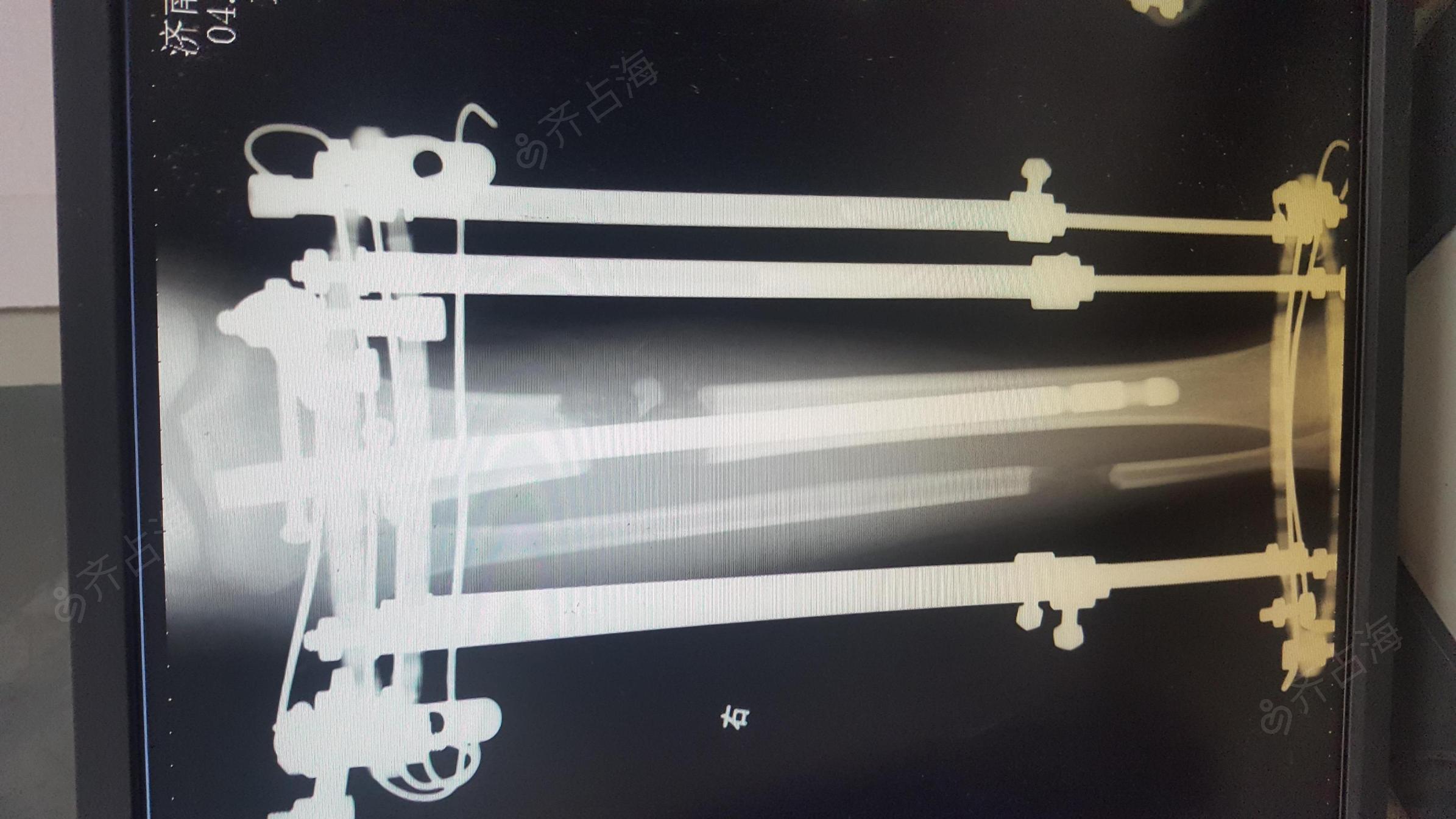 lon技术肢体延长治疗长短腿