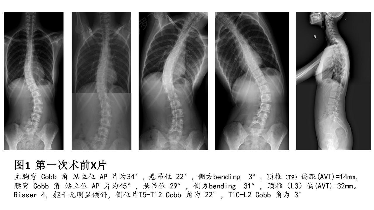 体格检查(全身查体&专科查体) 体型中等,营养良好,左肩高,腰部软组织