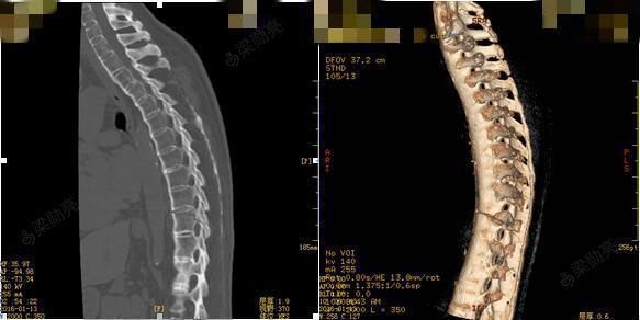 强直性脊柱炎脊柱骨折