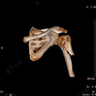 左肱骨近端骨折图片