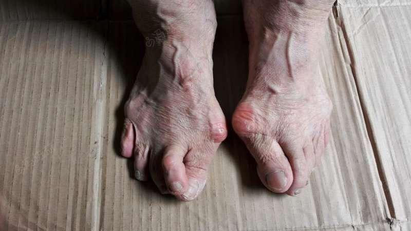 现病史 缘于20余年前无明显诱因出现双足踇趾外翻,踇趾内侧皮肤红肿