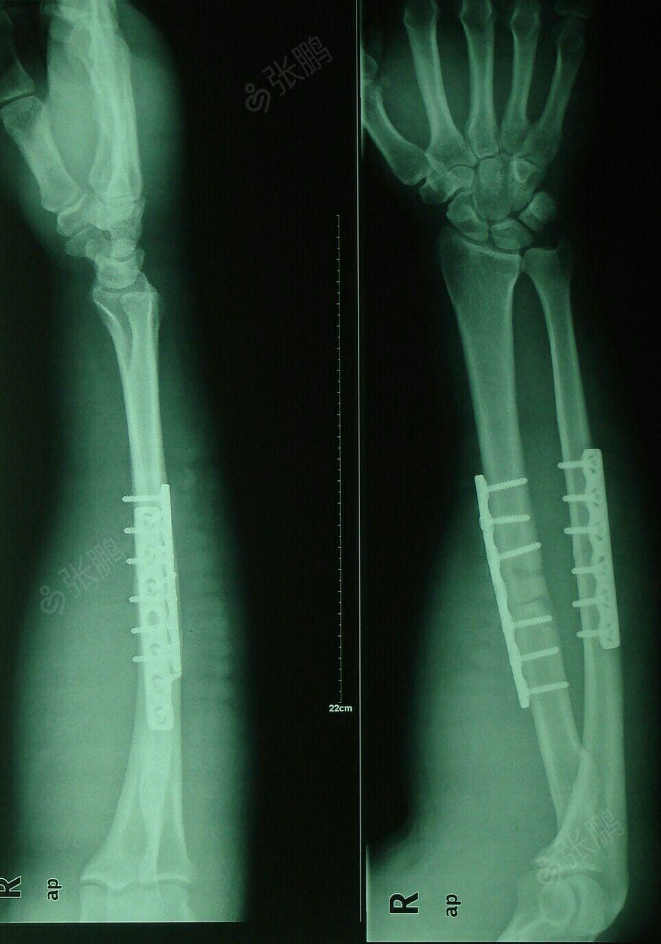前臂尺桡骨骨折的手术治疗