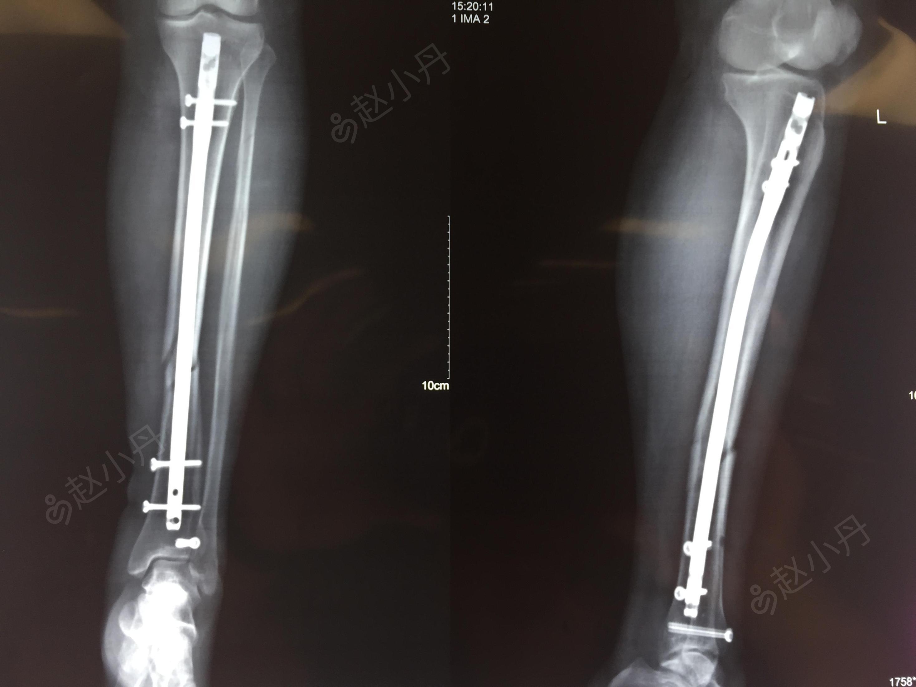 左脛腓骨中斷粉碎性骨折,左側脛骨後踝骨折