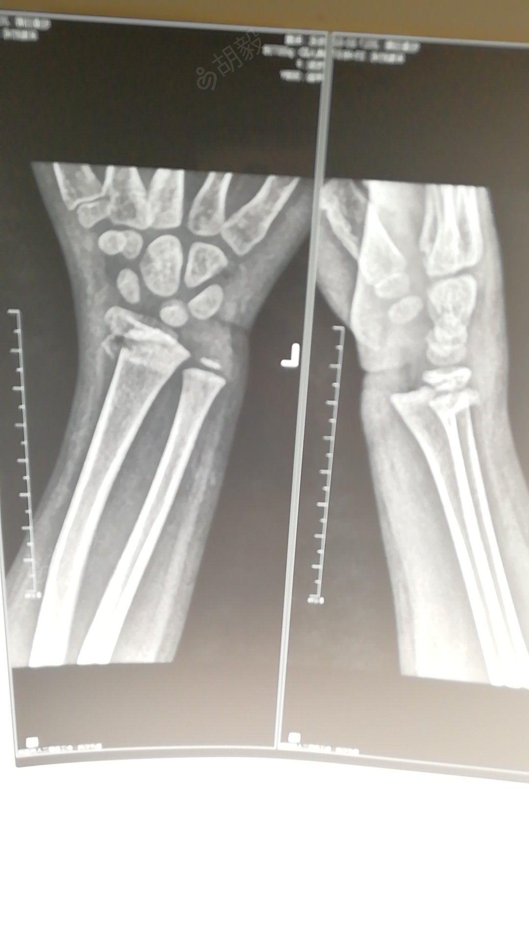 桡骨远端骨折手法复位