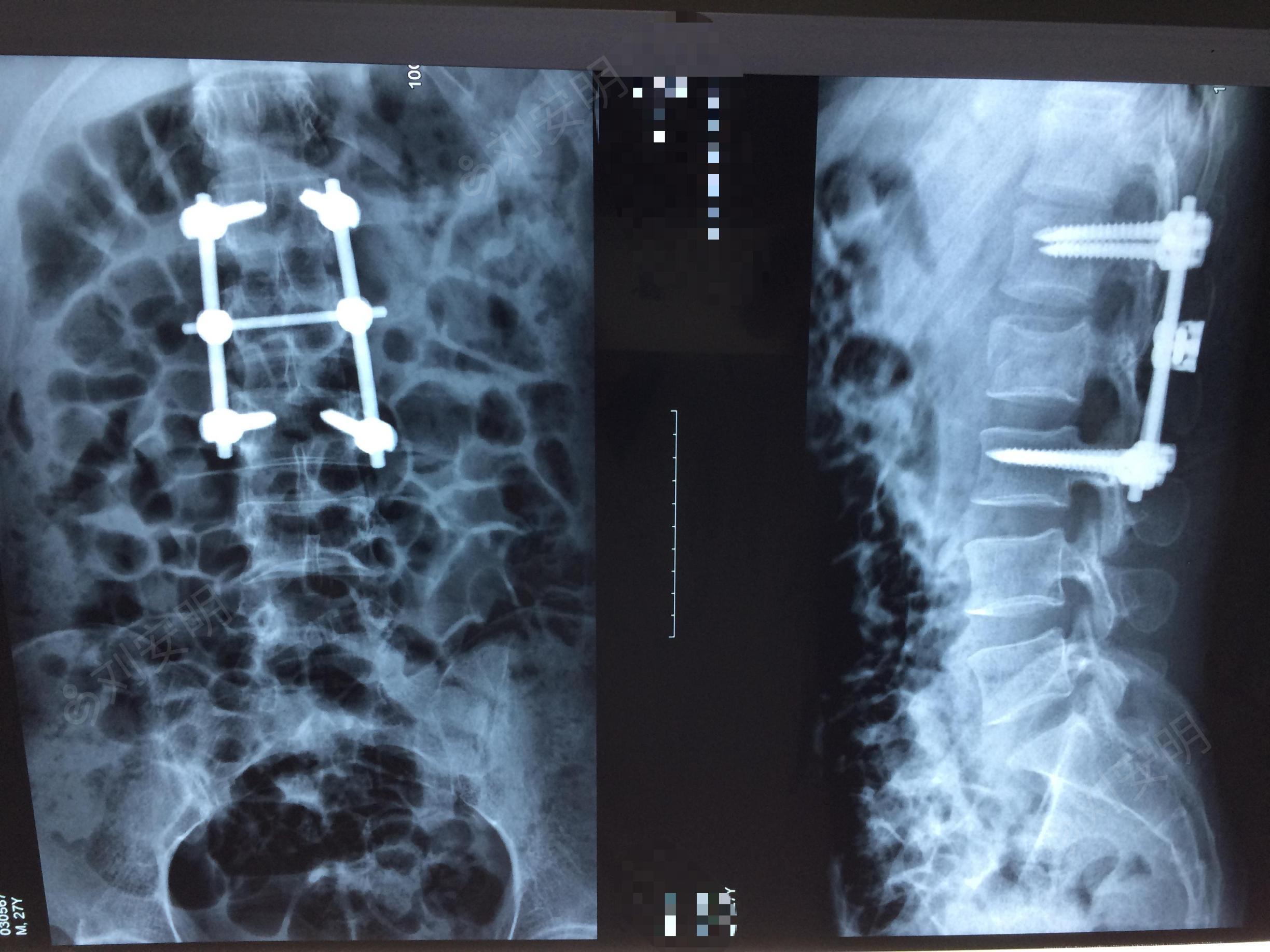 l2椎体骨折位置图图片