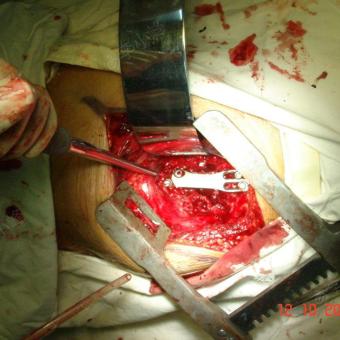 经胸腰椎前路行胸椎结核病灶清除植骨融合内固定术