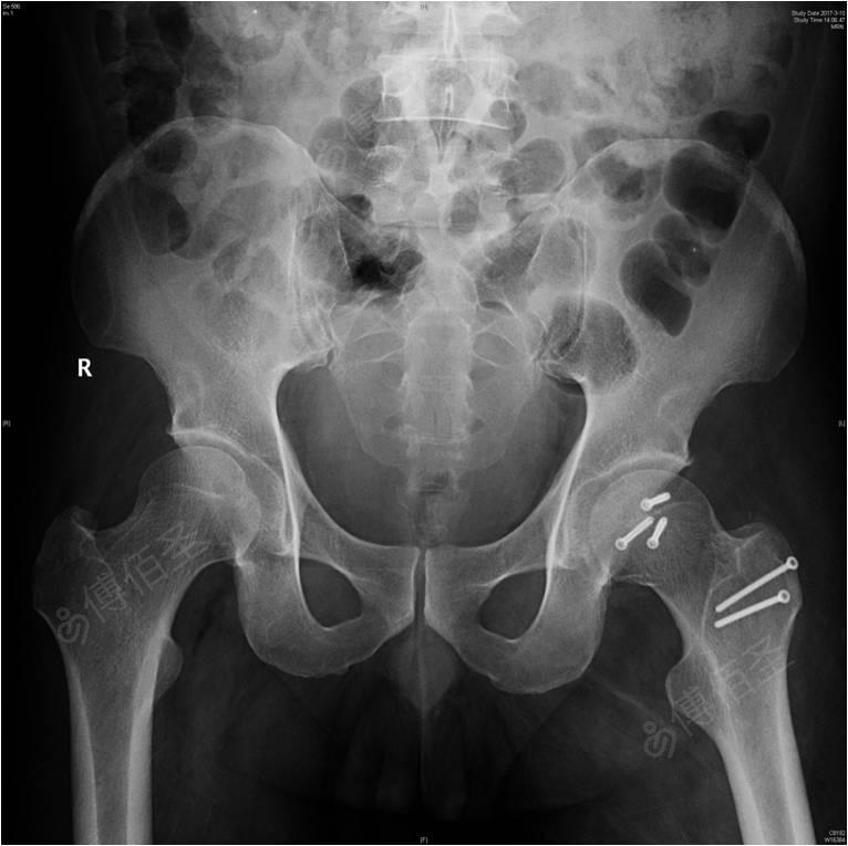 左侧股骨头骨折并髋关节脱位