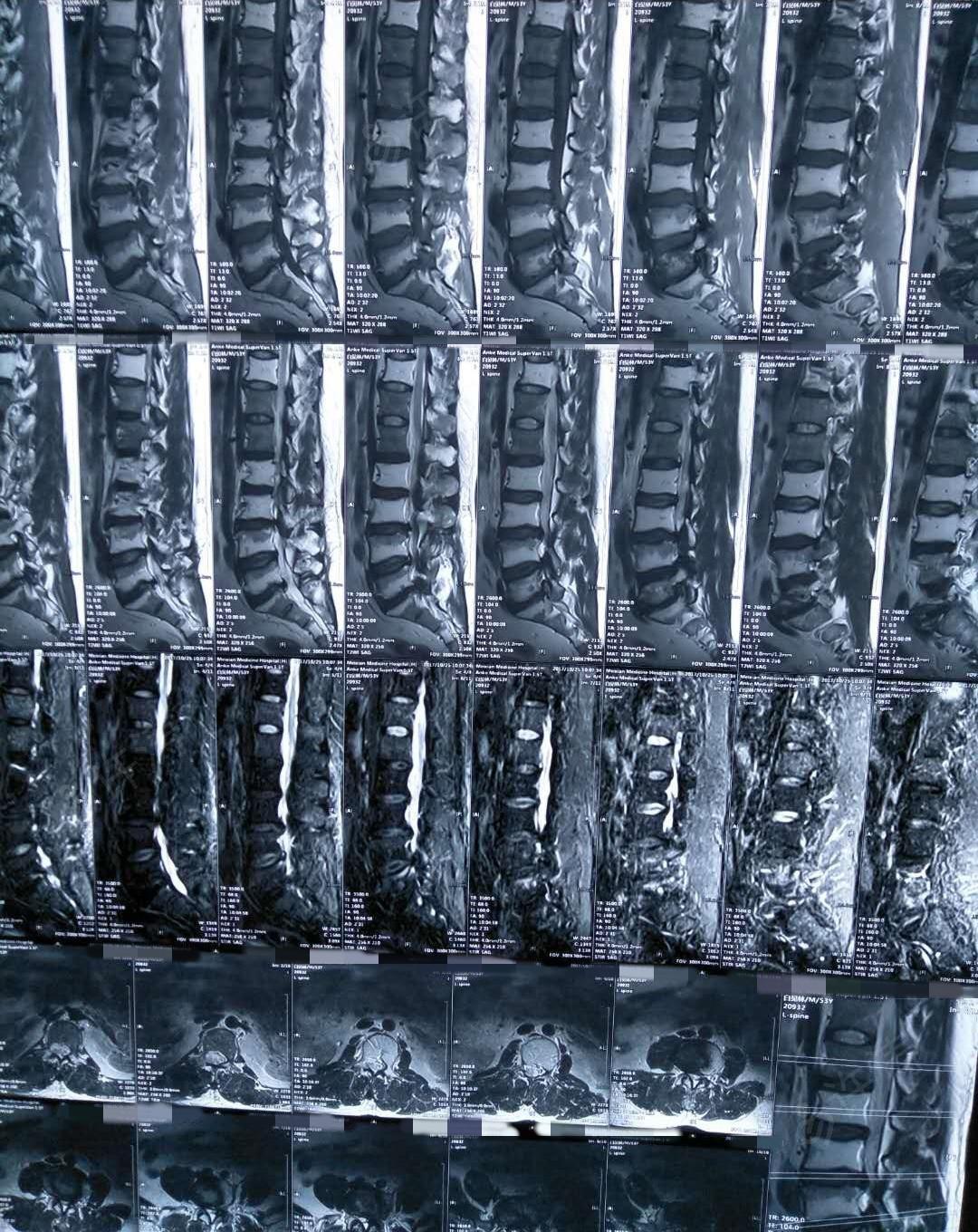 胸腰段脊柱椎体病变考虑什么?