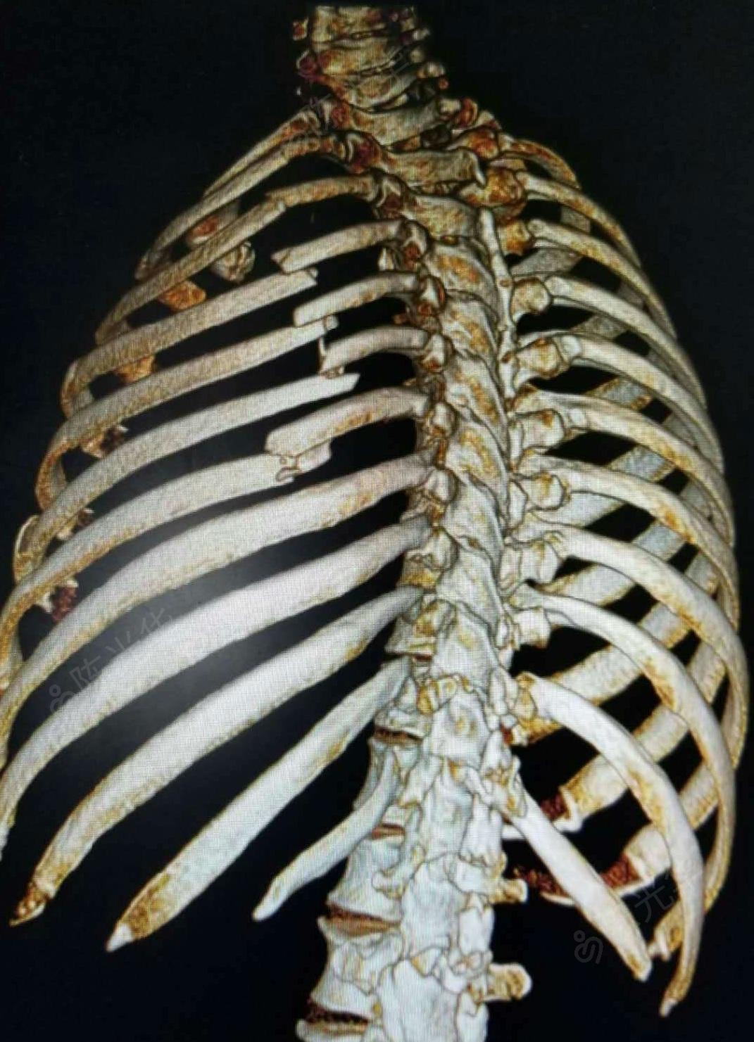 锁骨骨折伴多发性肋骨骨折