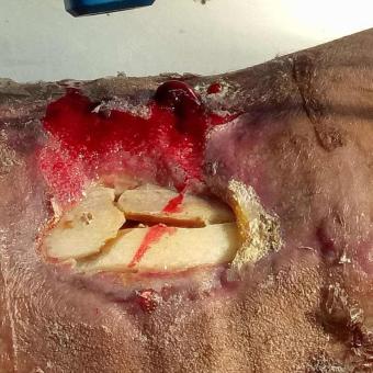 胫骨骨折后创伤性骨髓炎伴小腿前侧皮肤缺损