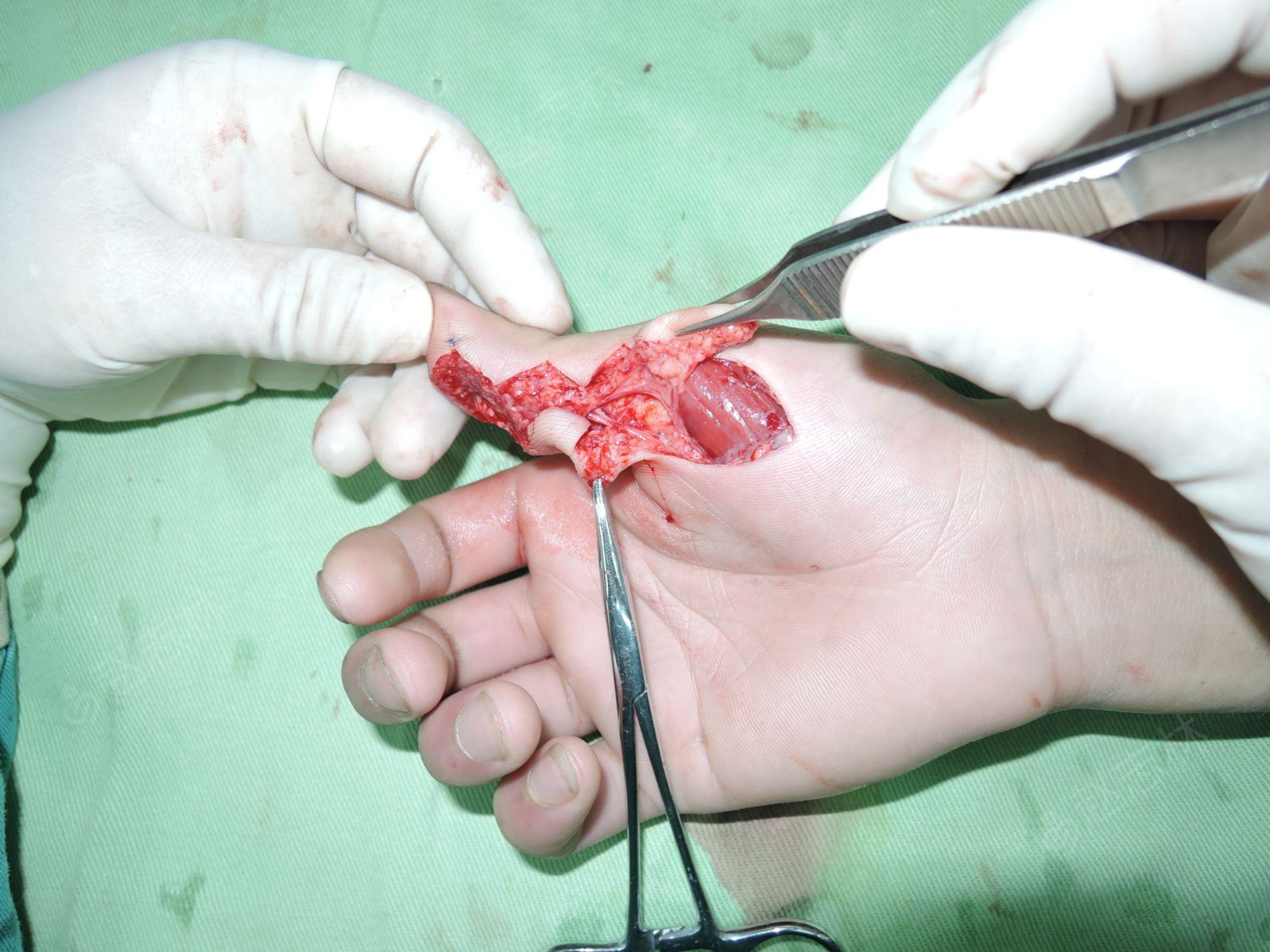 大鱼际带蒂皮瓣手术图图片