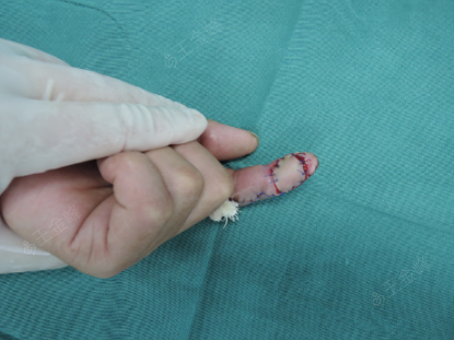 典型指腹皮肤缺损指动脉皮瓣修复