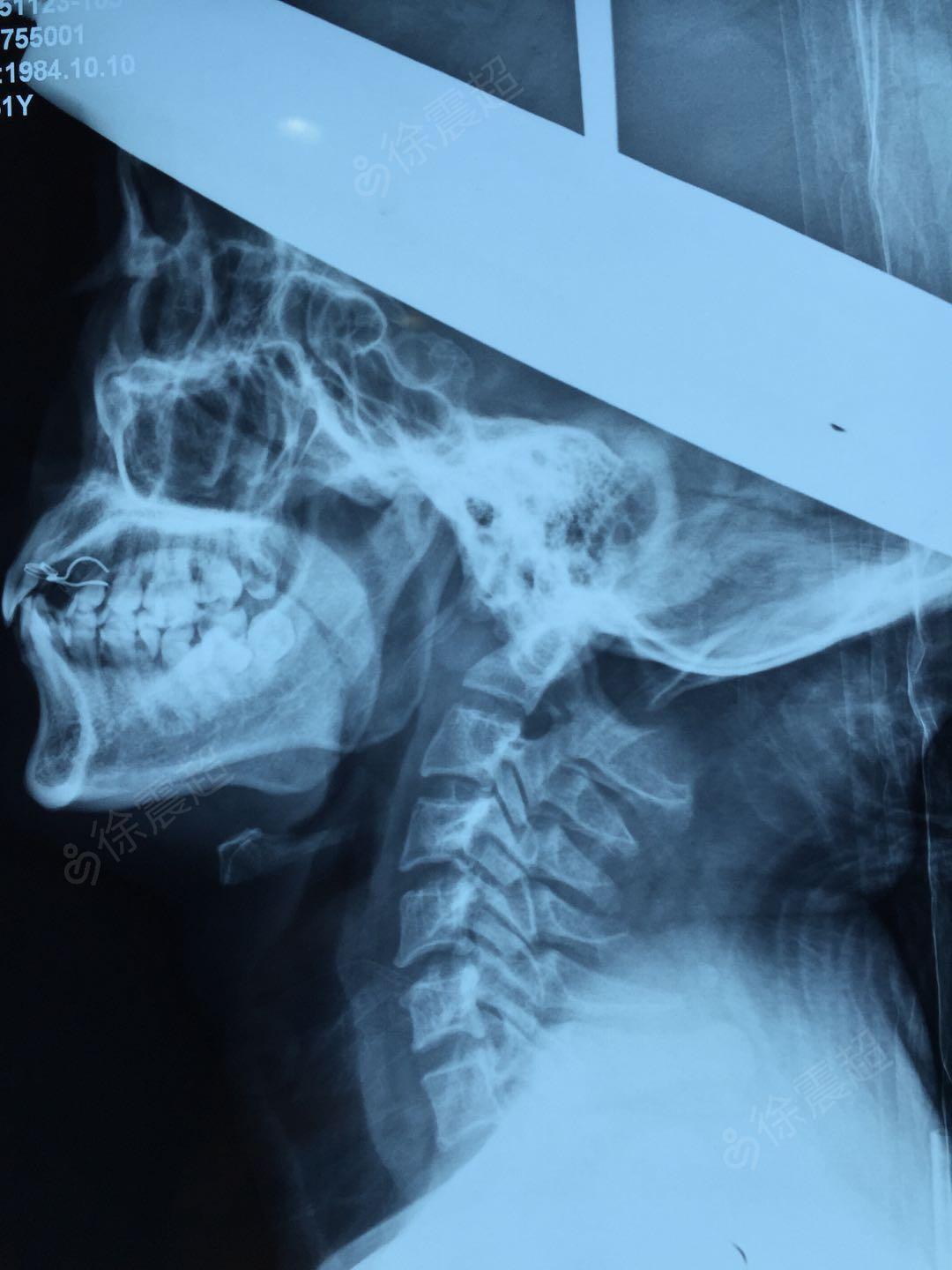 寰枢关节半脱位