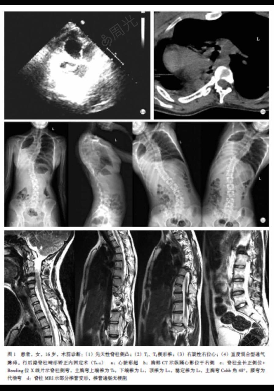 脊柱呈"s"型侧凸,胸段凸向右侧,左肩稍高,左肩胛骨向后突起,右侧轻度"