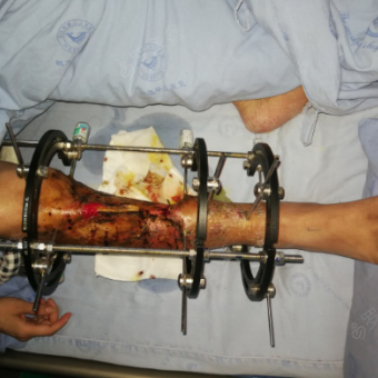 右侧胫腓骨开放性粉碎性骨折ilizarov修复术