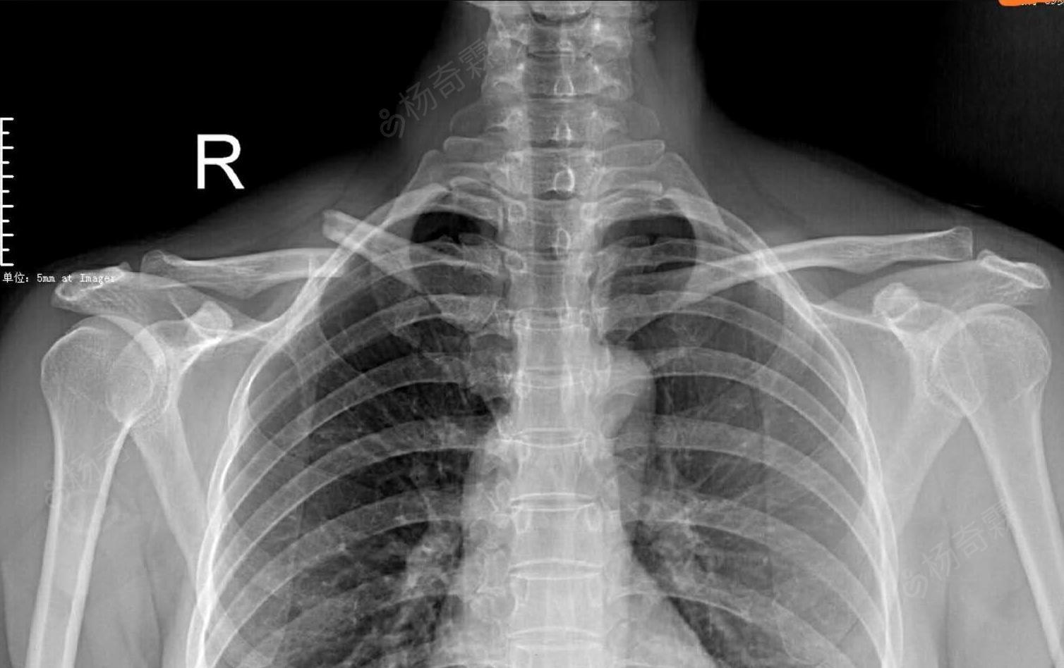 胸锁关节拍片位置图片