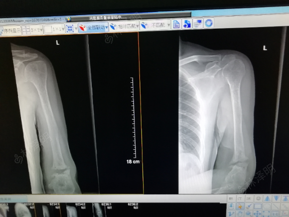 左肱骨幹陳舊性骨折不癒合